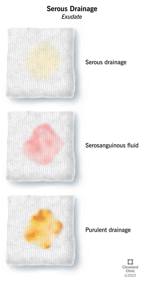 purulent drainage vs serous|Wound Exudate: What Does This Color Mean for My。